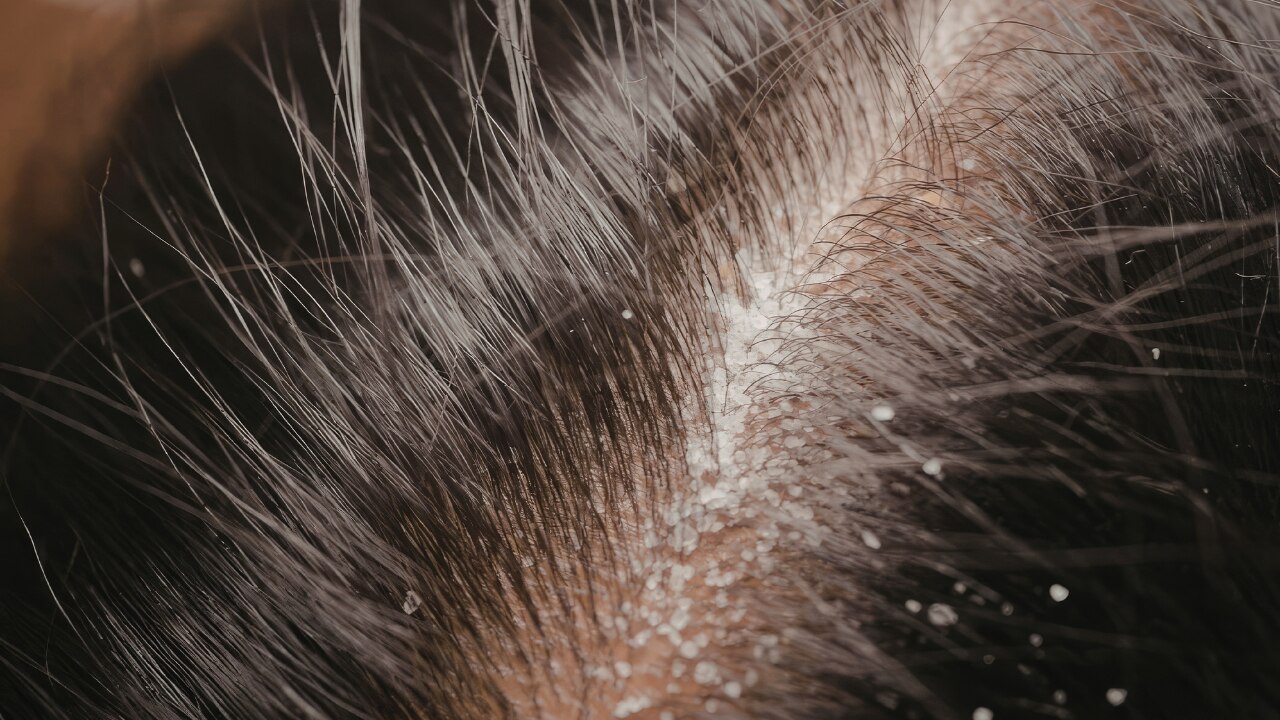 Why Scalp Health Matters for Hair Growth