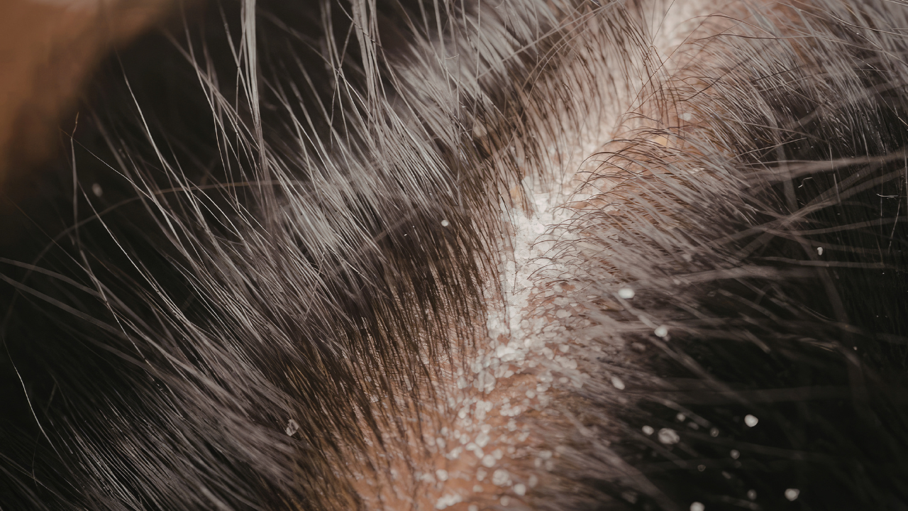 Why Scalp Health Matters for Hair Growth