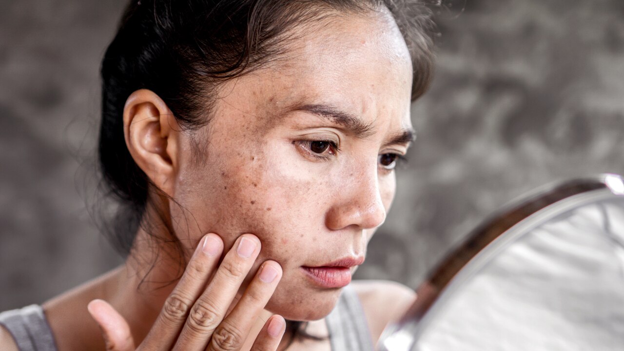 Types of Hyperpigmentation
