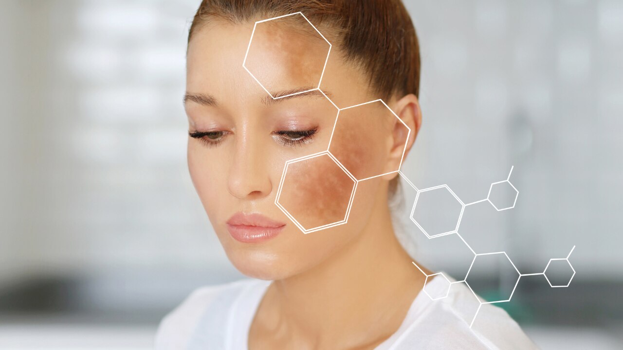 What Are Dark Spots?