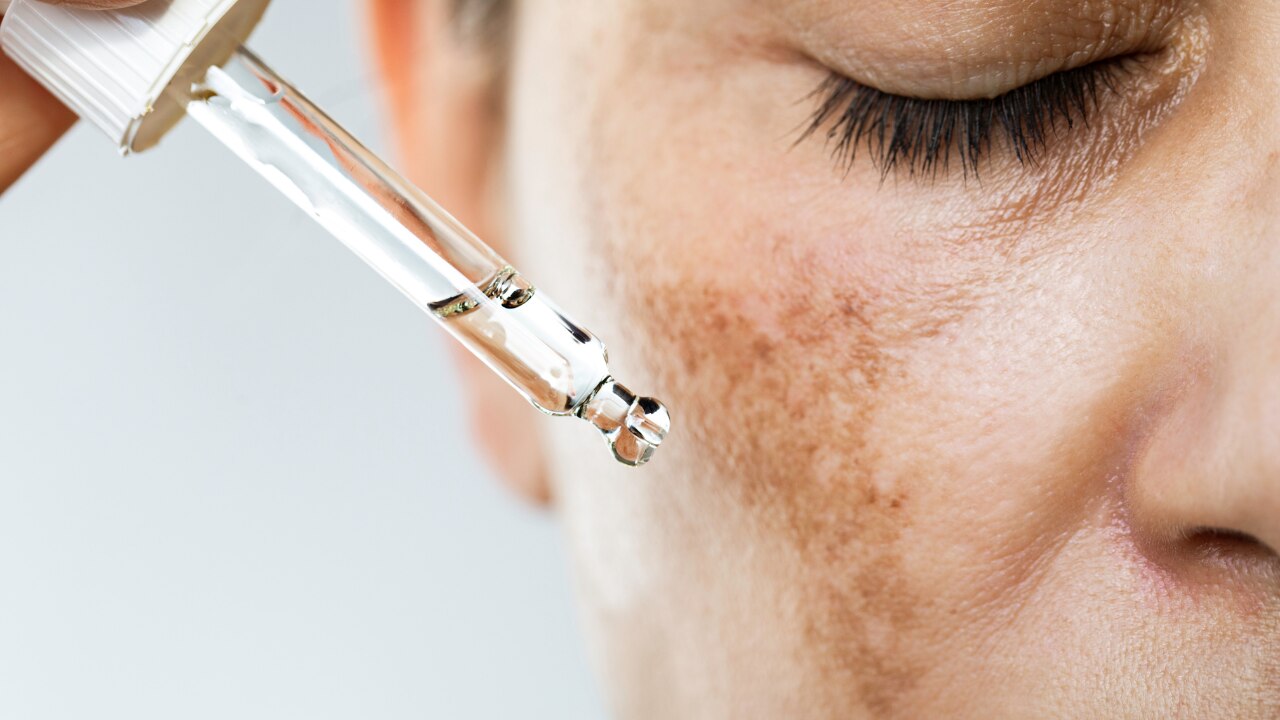 What Is Hyperpigmentation?