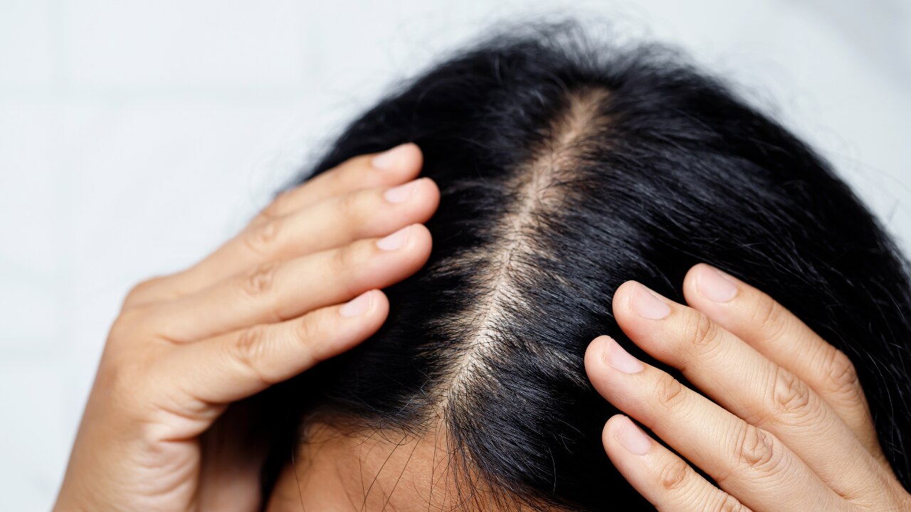 Signs Your Scalp Is Producing Excess Oil