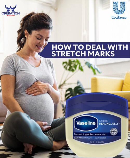 Vaseline how to deal with stretch marks article