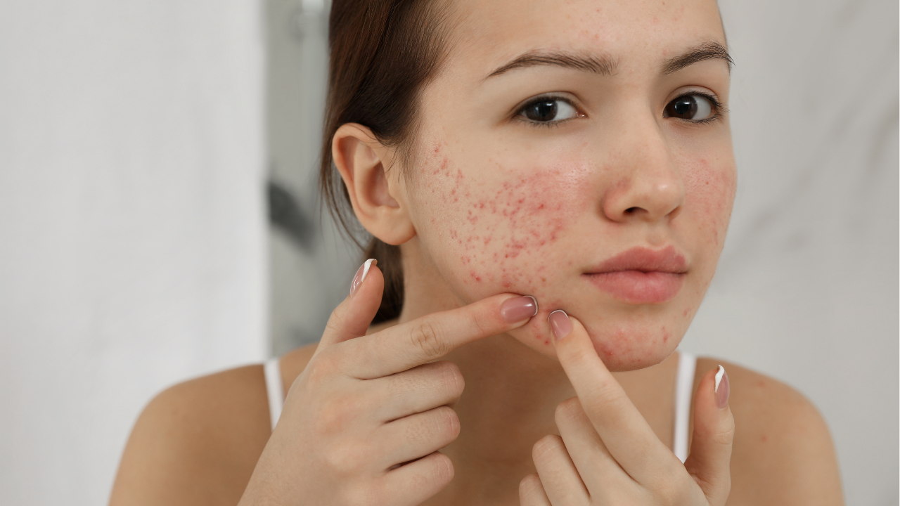 Acne-Prone Skin