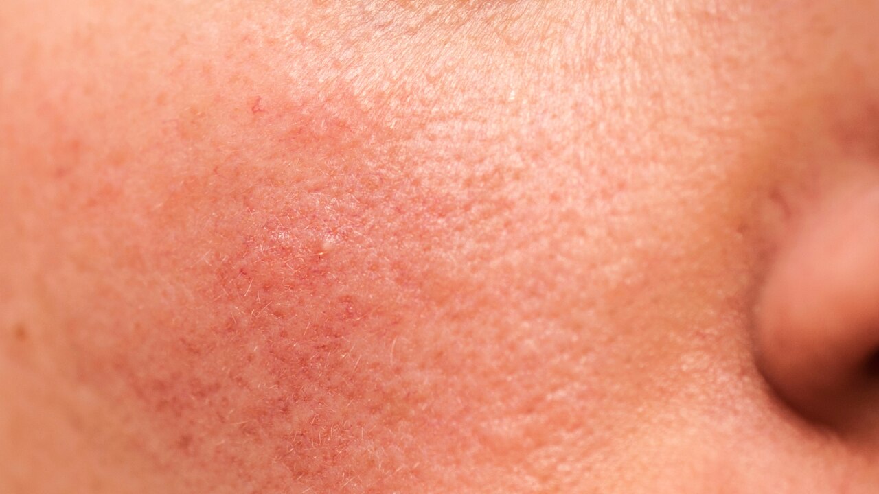 Sensitive Skin