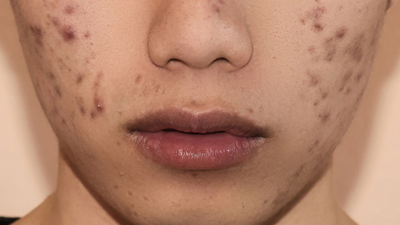Areas Where Fungal Acne Commonly Appears