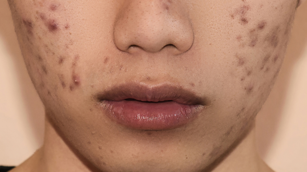 Areas Where Fungal Acne Commonly Appears