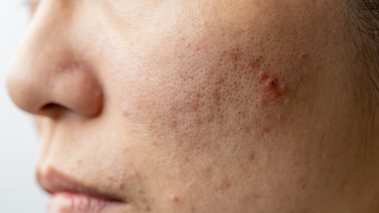 Common Signs of Fungal Acne