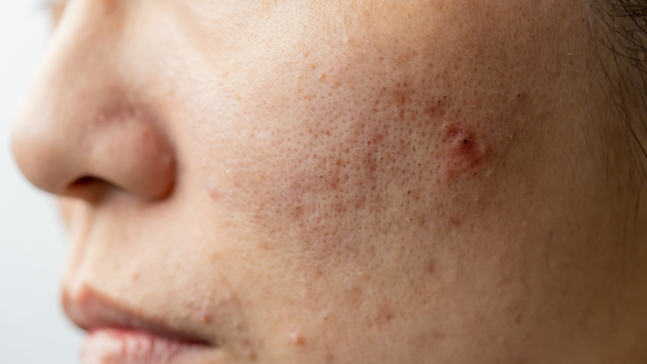 Common Signs of Fungal Acne