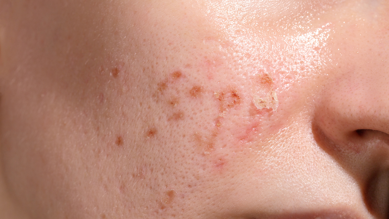 Fungal Acne