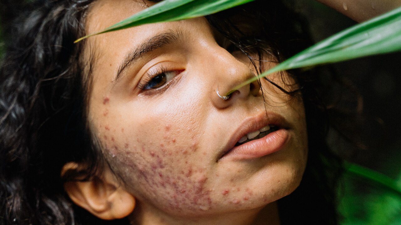 How to Manage Fungal Acne During Monsoon