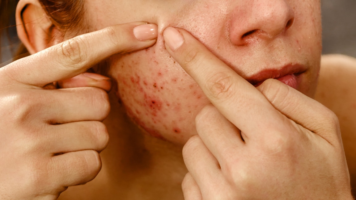 linking article: Fungal Acne in Monsoon: Signs, Causes & How to Keep Breakouts Under Control