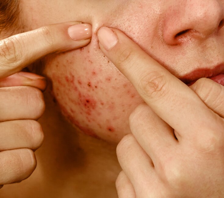 Image of Fungal Acne in Monsoon: Signs, Causes & How to Keep Breakouts Under Control
