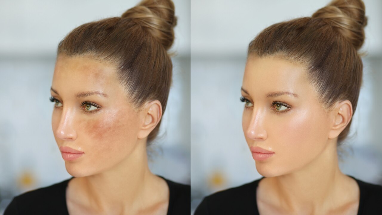 Common Mistakes When Treating Dark Spots