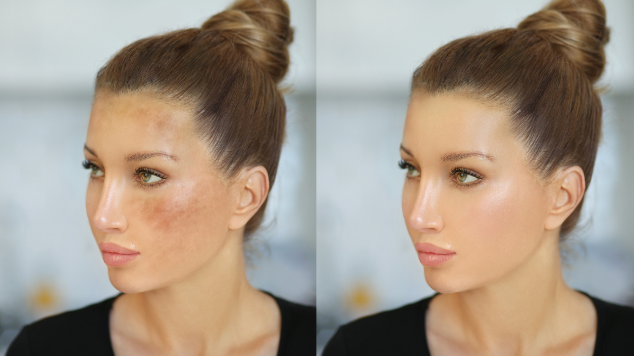 Common Mistakes When Treating Dark Spots