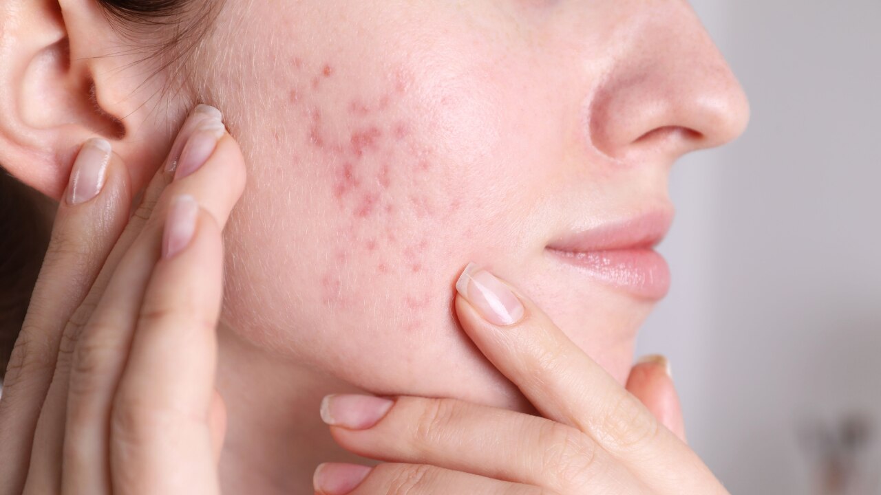 FUNGAL ACNE ISN’T ACTUALLY ACNE