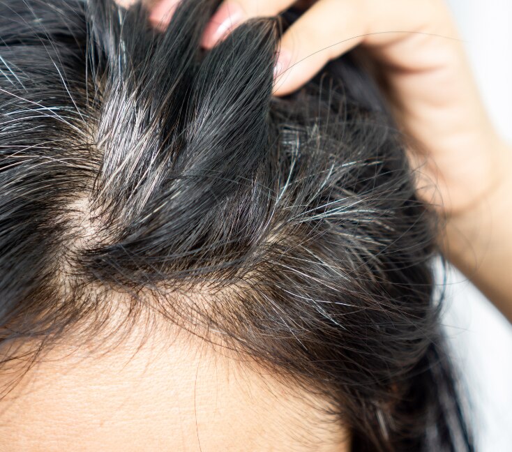Image of Premature Grey Hair: Causes, Prevention & Can It Be Really "Reversed"?