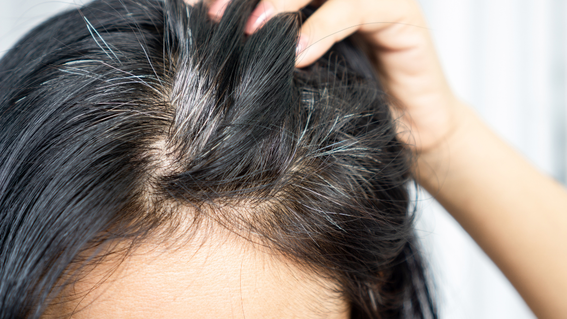 Premature Grey Hair Causes Prevention and Treatment Guide