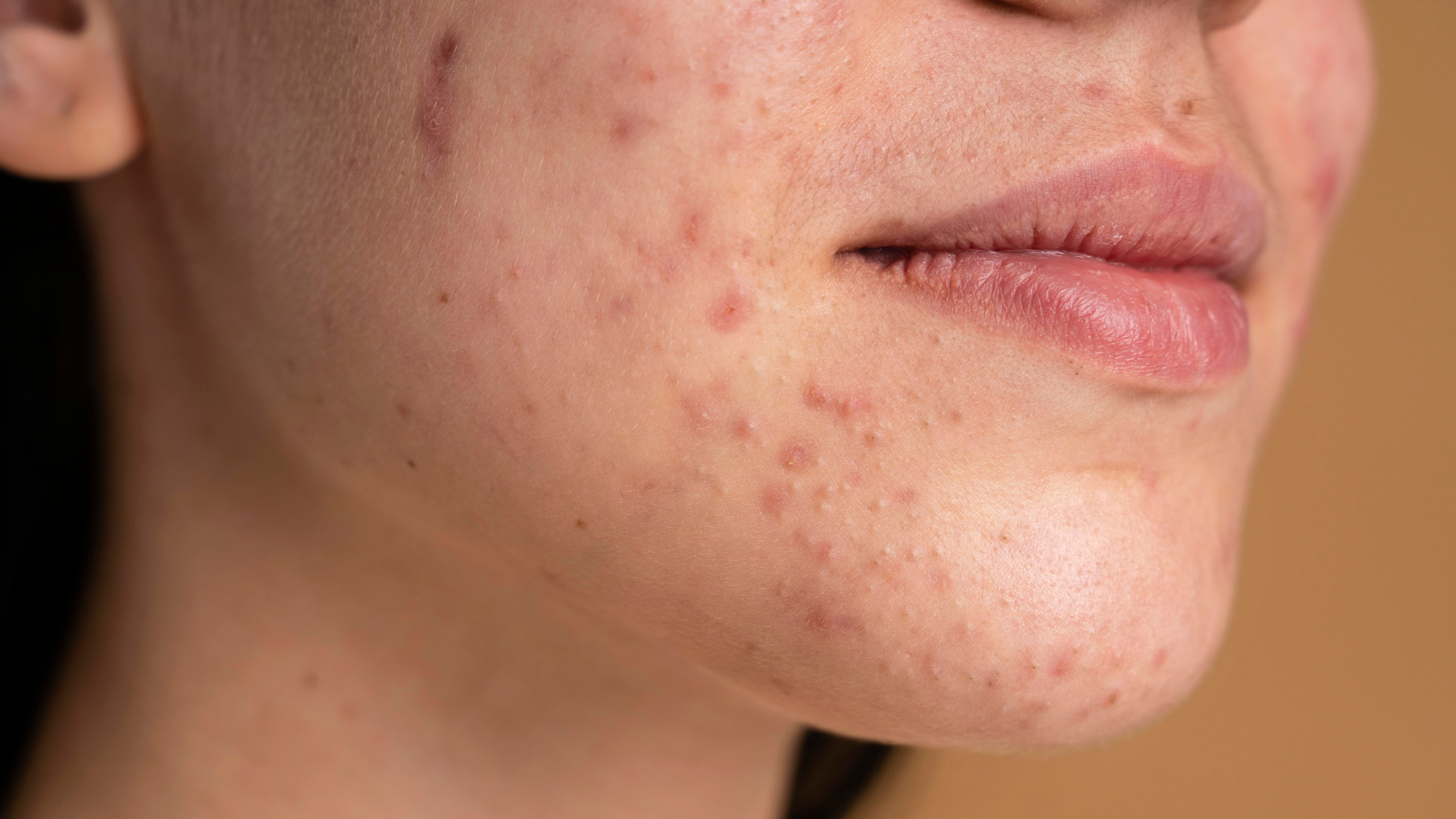 Acne-Prone Skin: