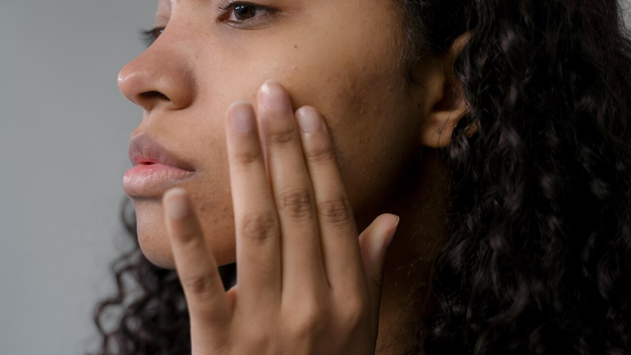 Can Tea Tree Oil Help With Acne?
