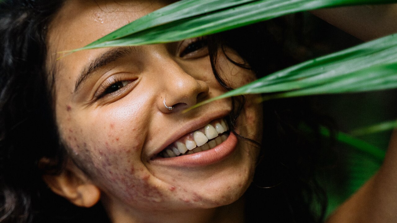 Gentle Alternative to Some Acne Treatments