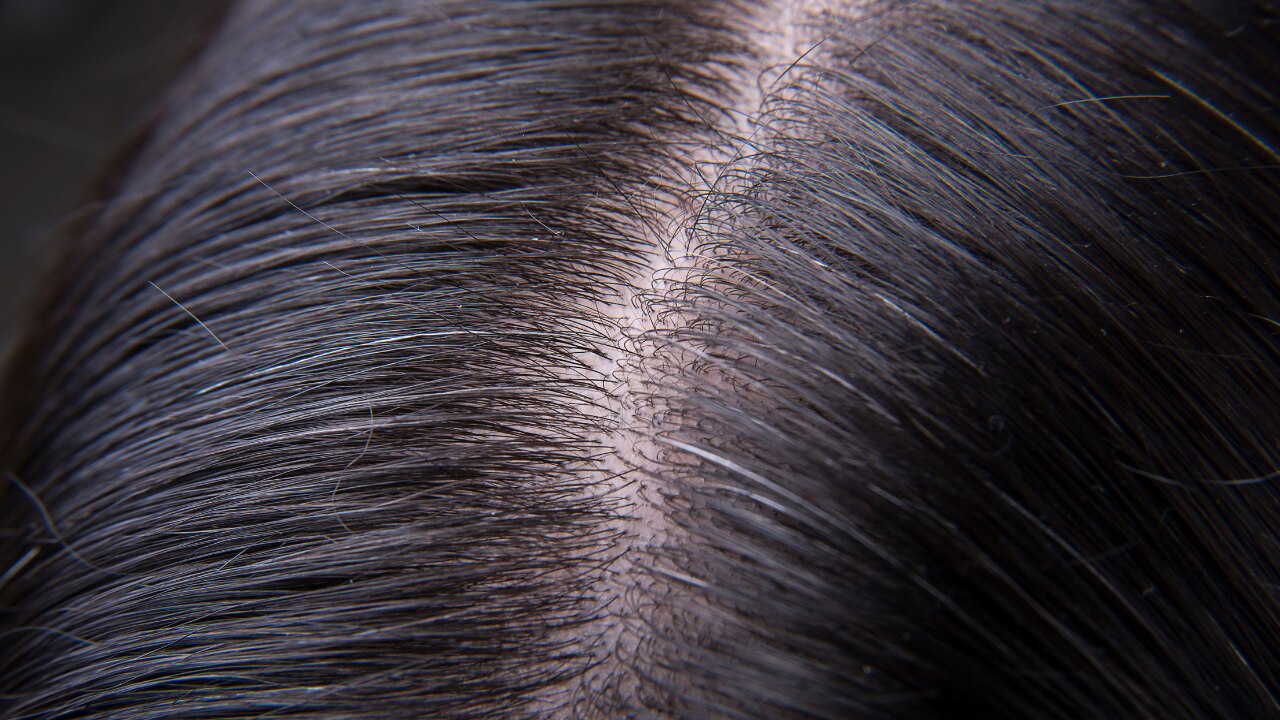 Identify Your Scalp Type