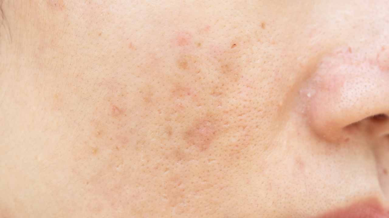 Expert Tips to Remove Acne Spots