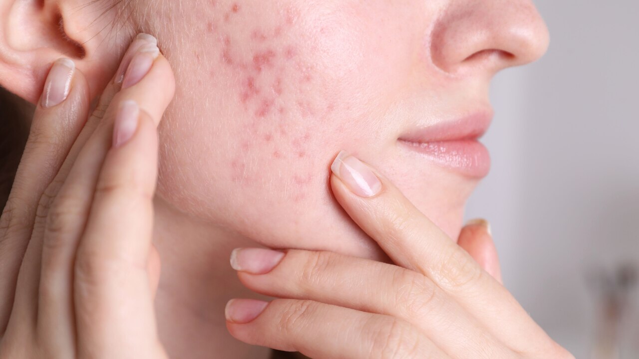 What Is an Acne Spot Treatment?