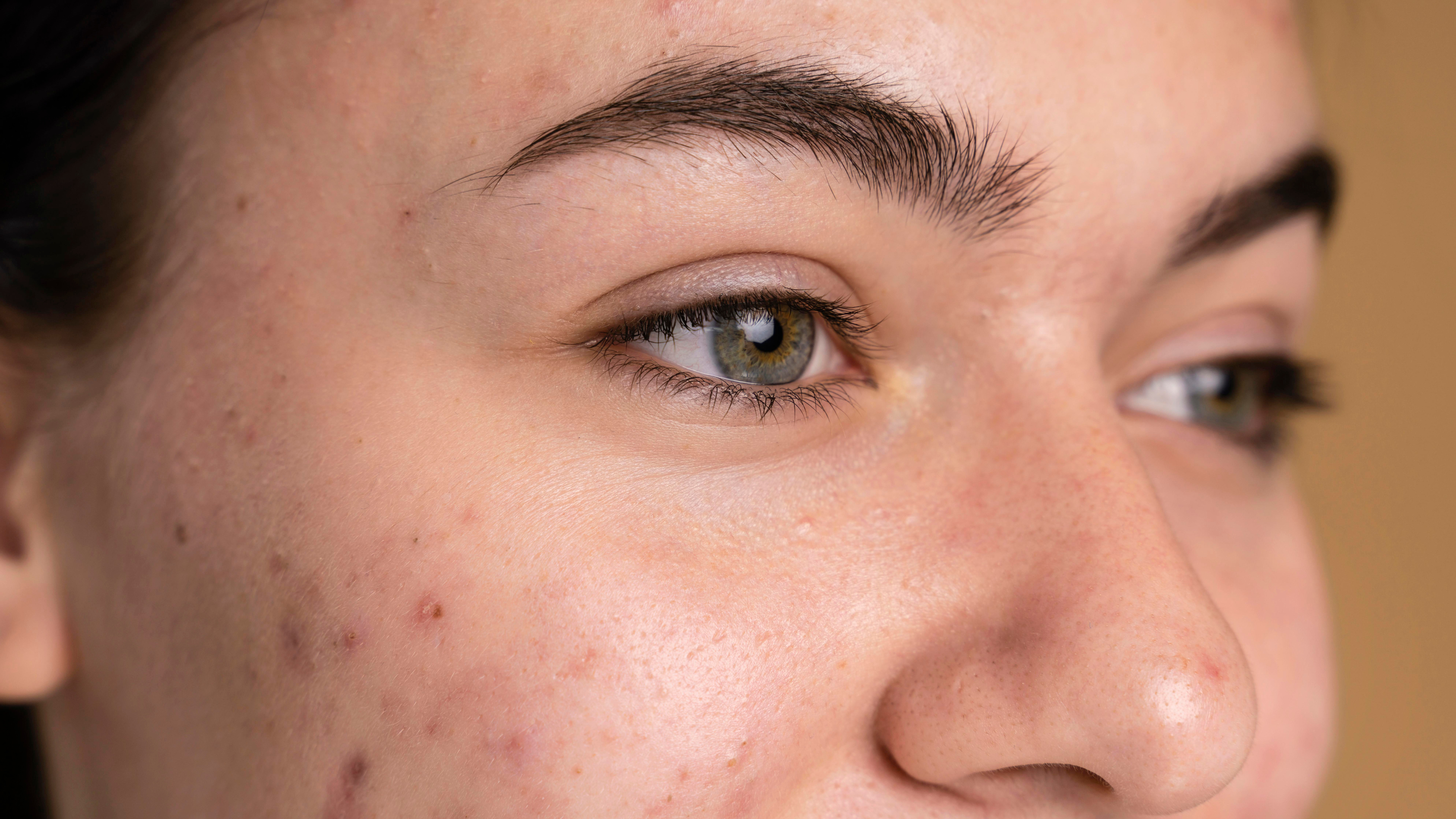 Reduces the Appearance of Post-Acne Marks