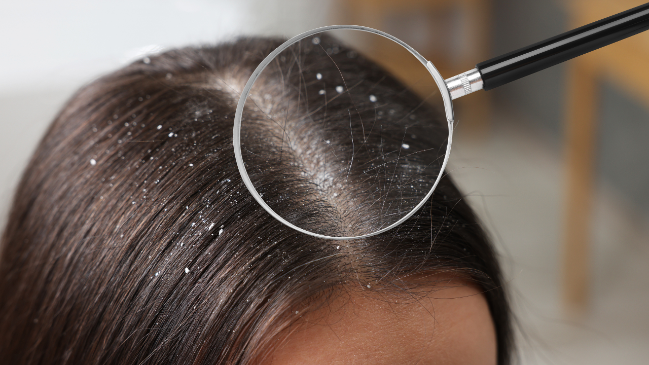 Signs and Symptoms of Oily Dandruff