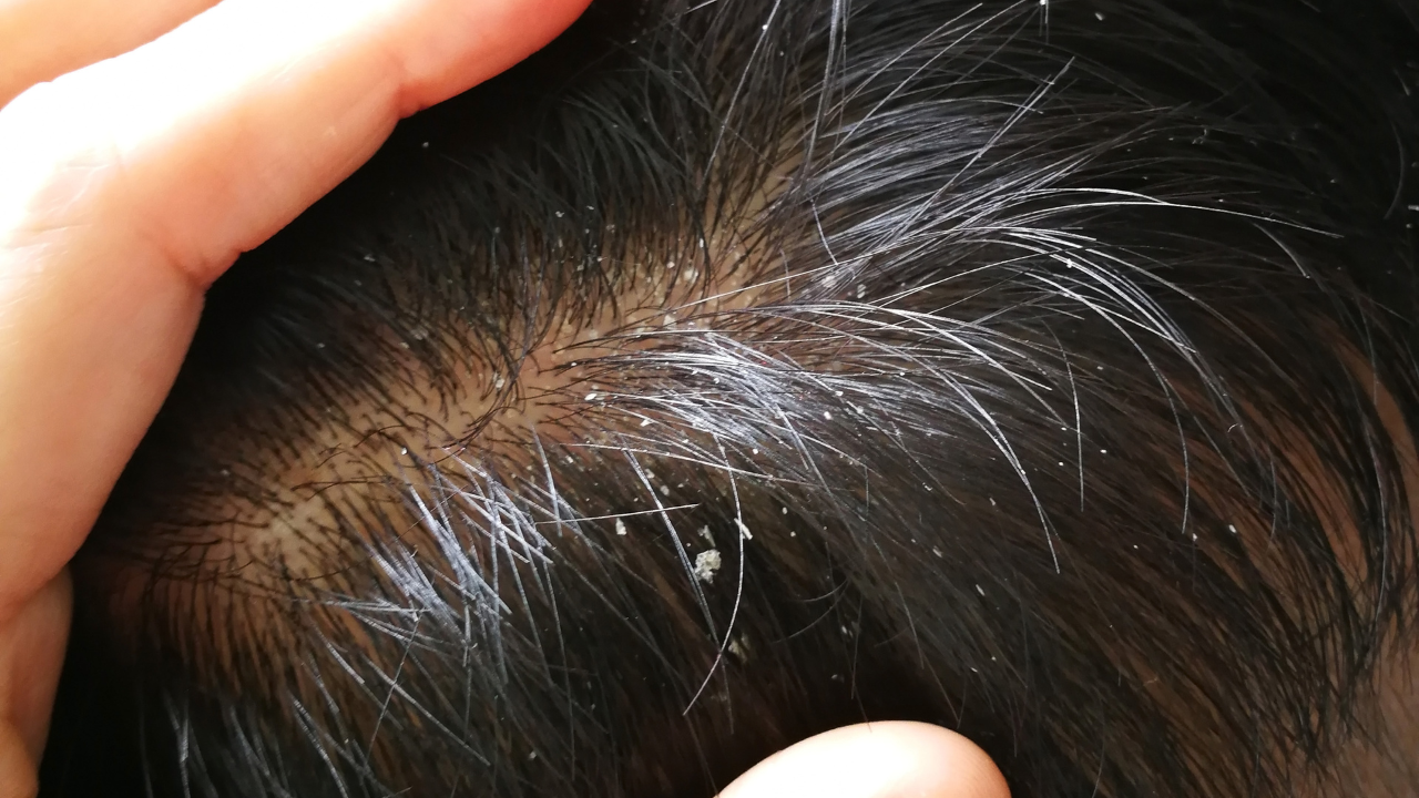 What Is Oily Dandruff?