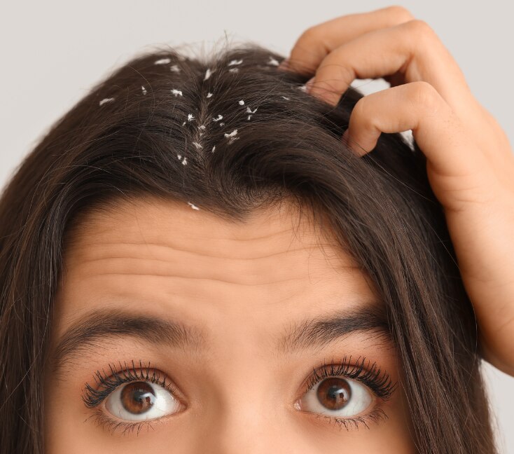 Image of Oily Dandruff: Why It Happens & What Actually Helps