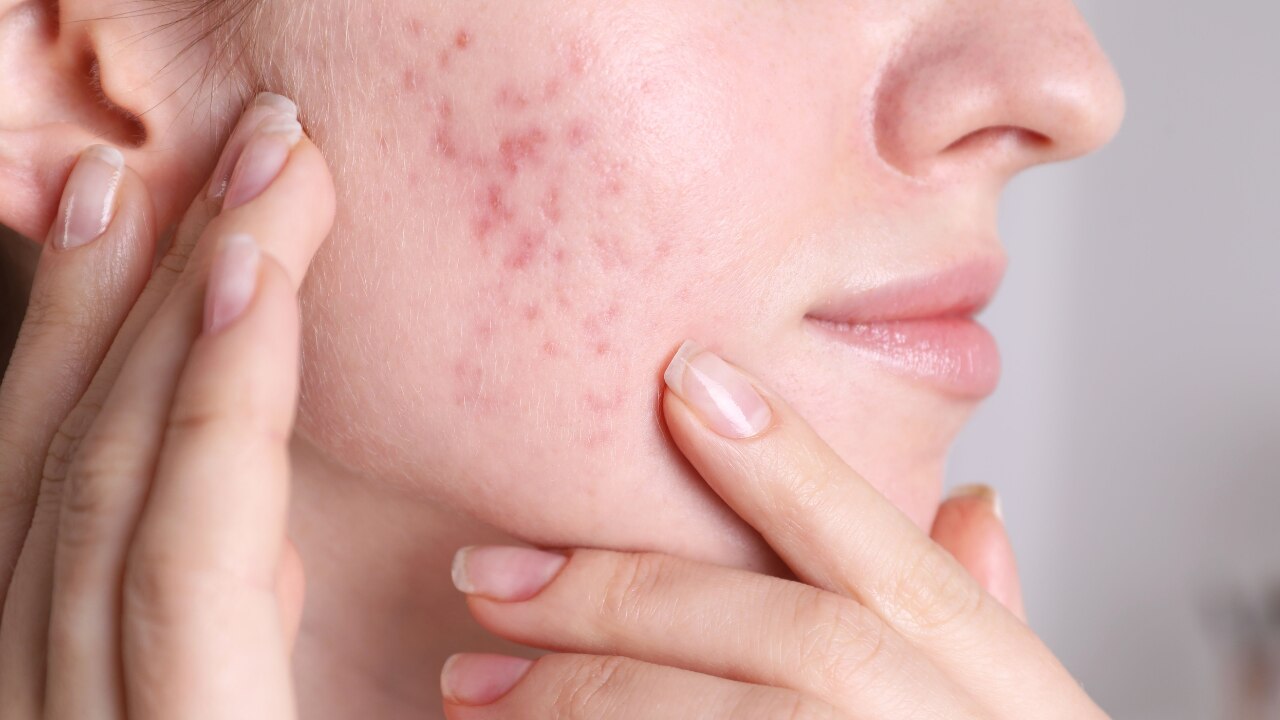 Why Acne-Prone Skin Needs a Dedicated Skincare Routine