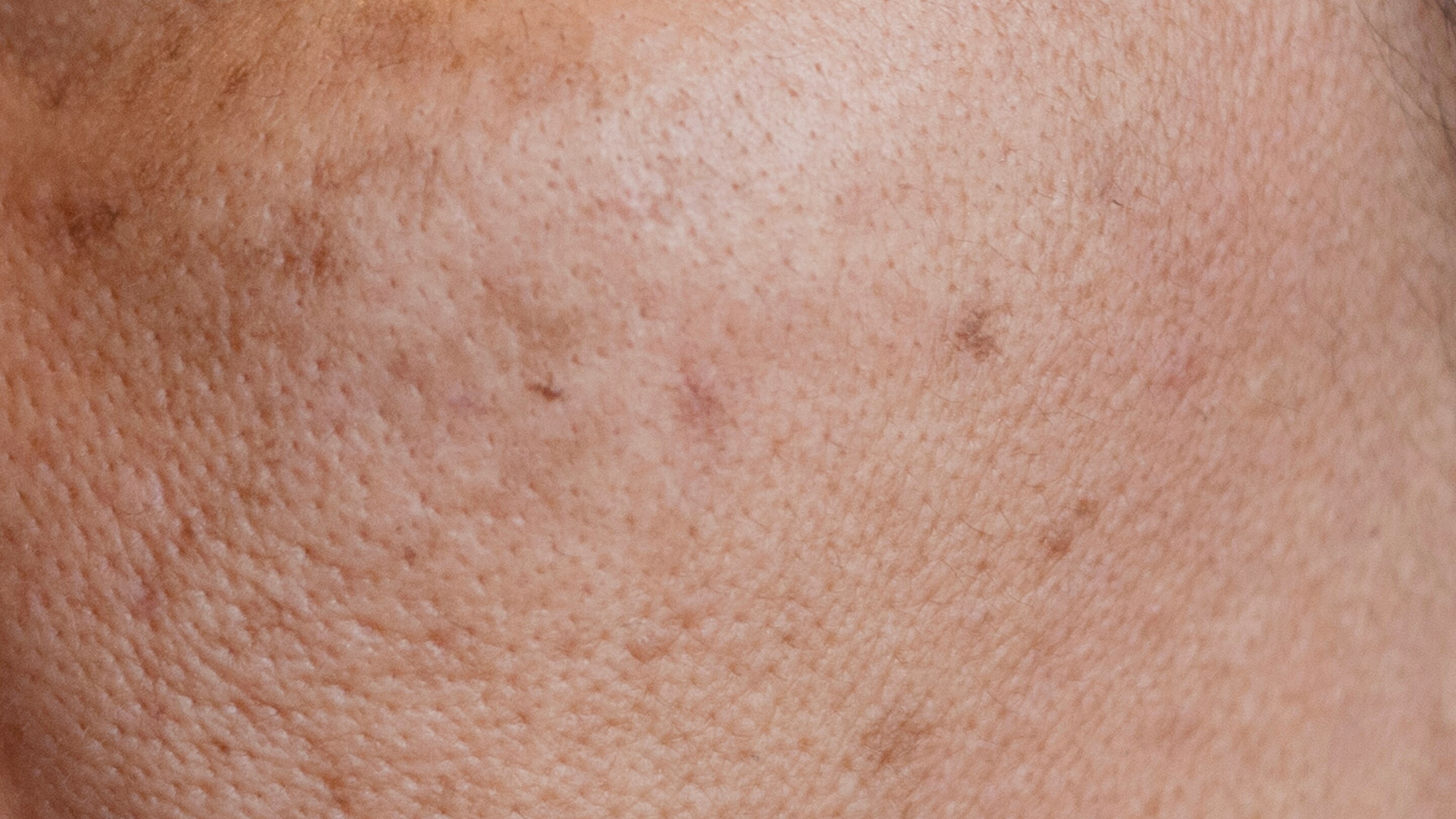 Blocked pores