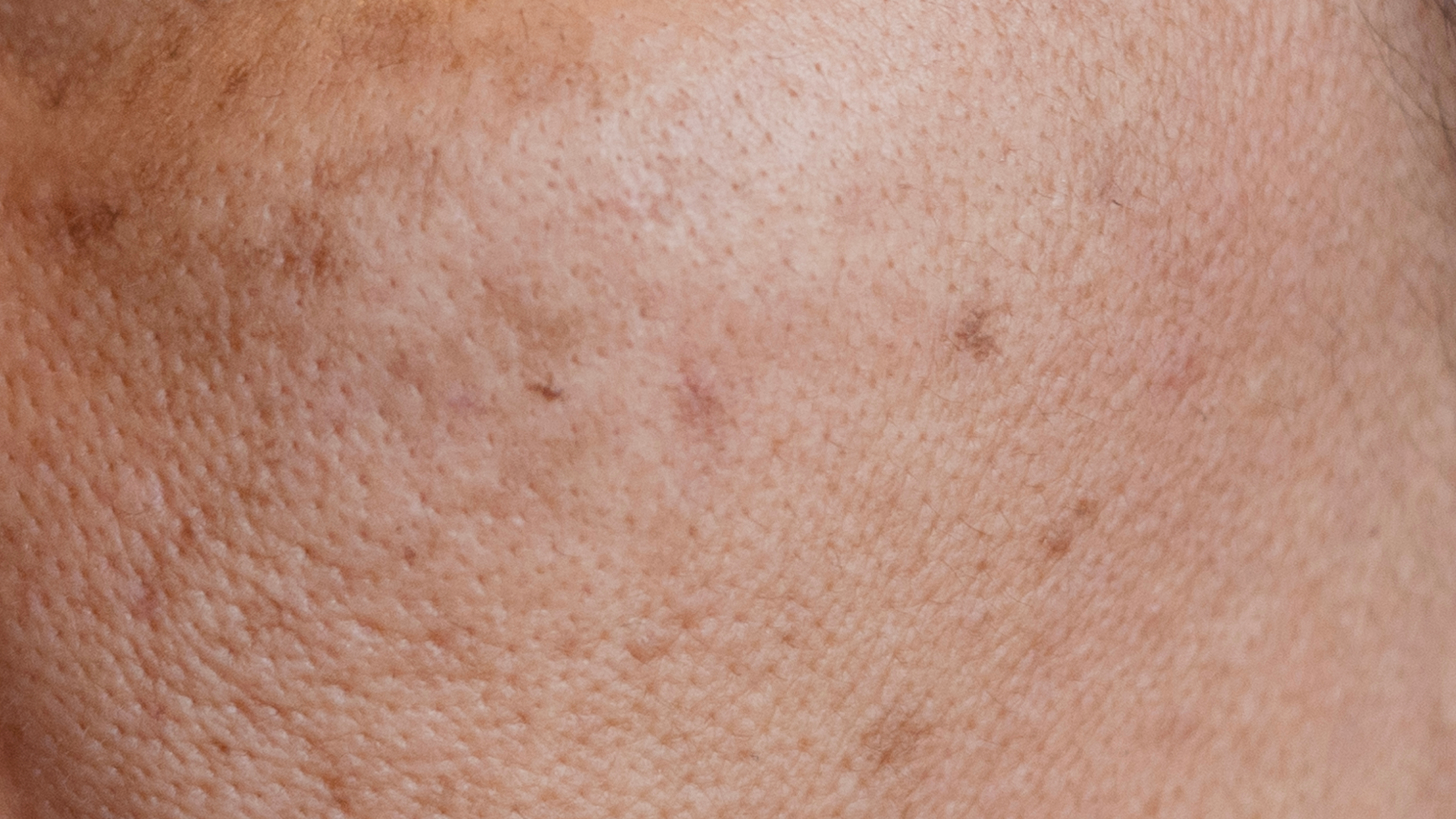 Blocked pores