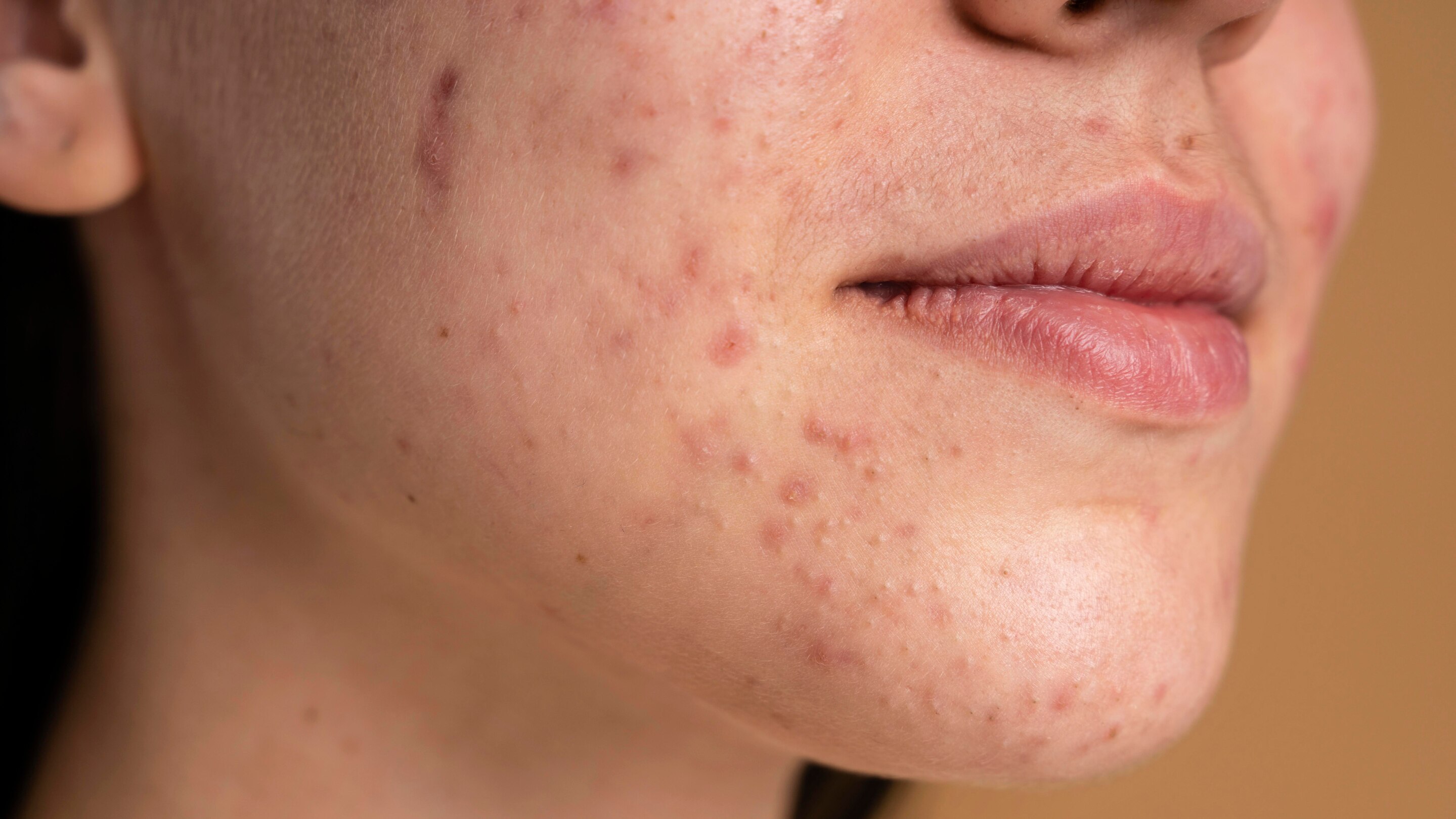 What Causes Active Acne?