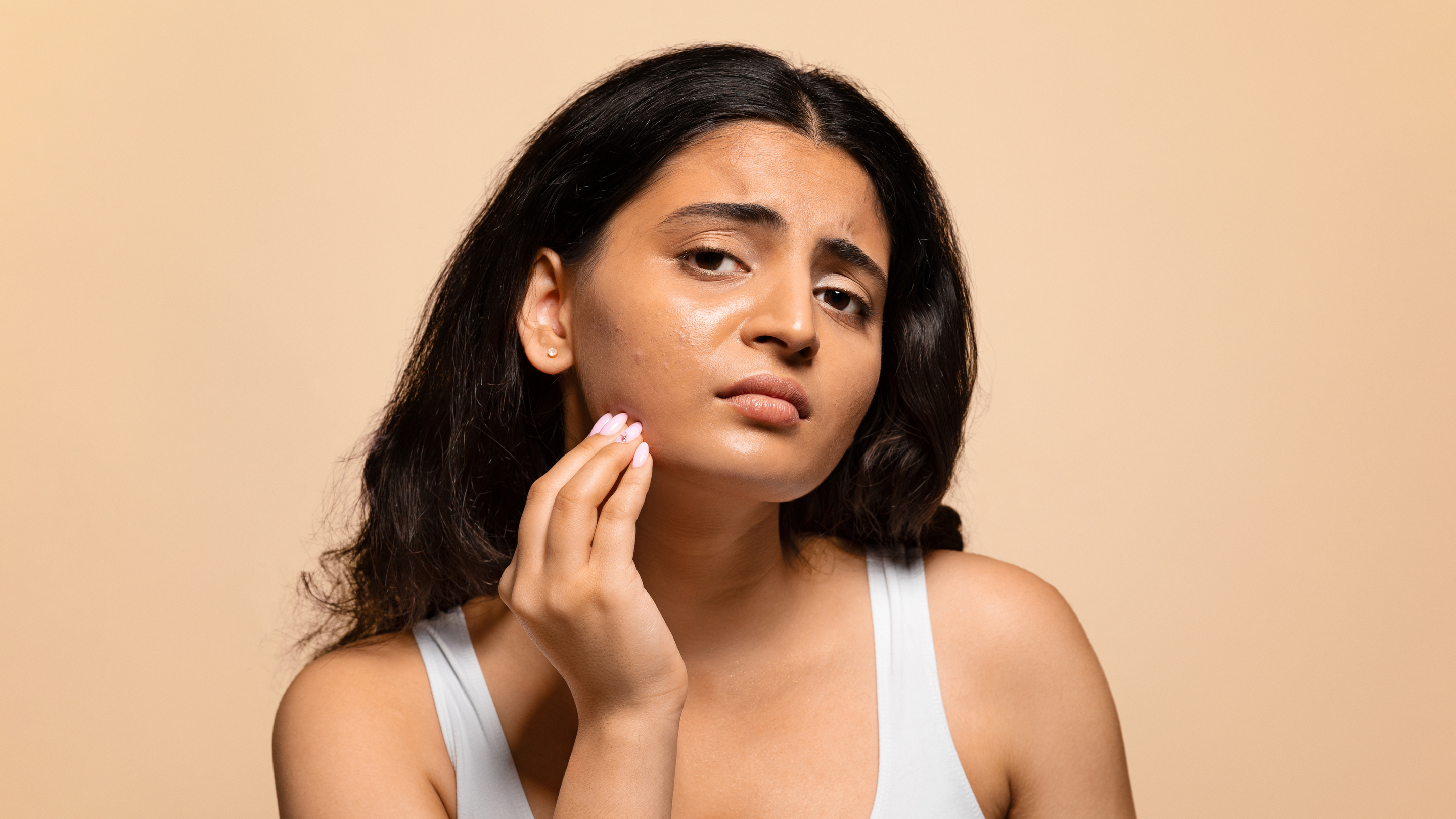 What Doesn't Work: Common Myths About Active Acne