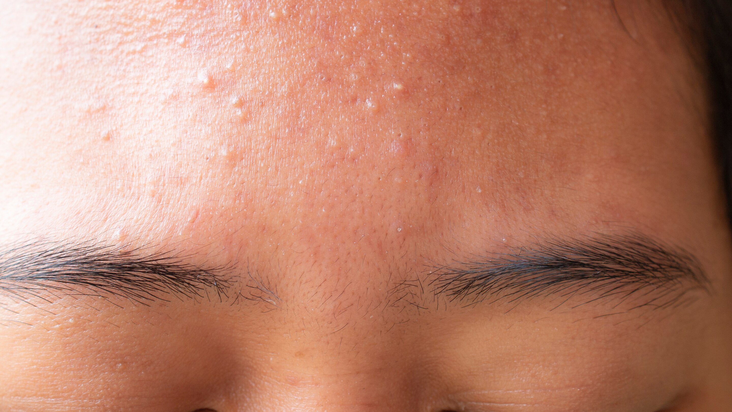 Acne-causing bacteria
