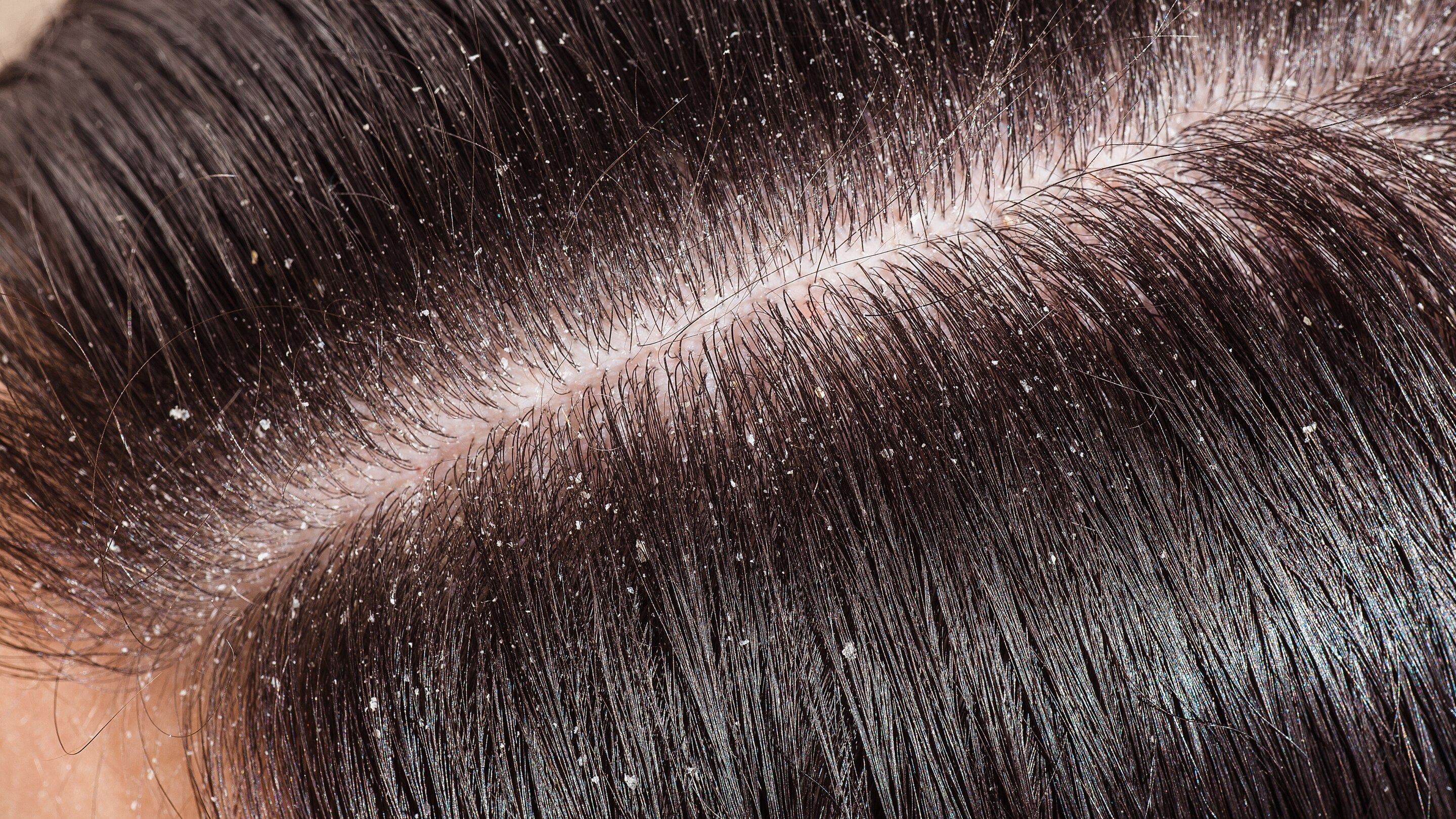 Who Should Exfoliate Their Scalp?