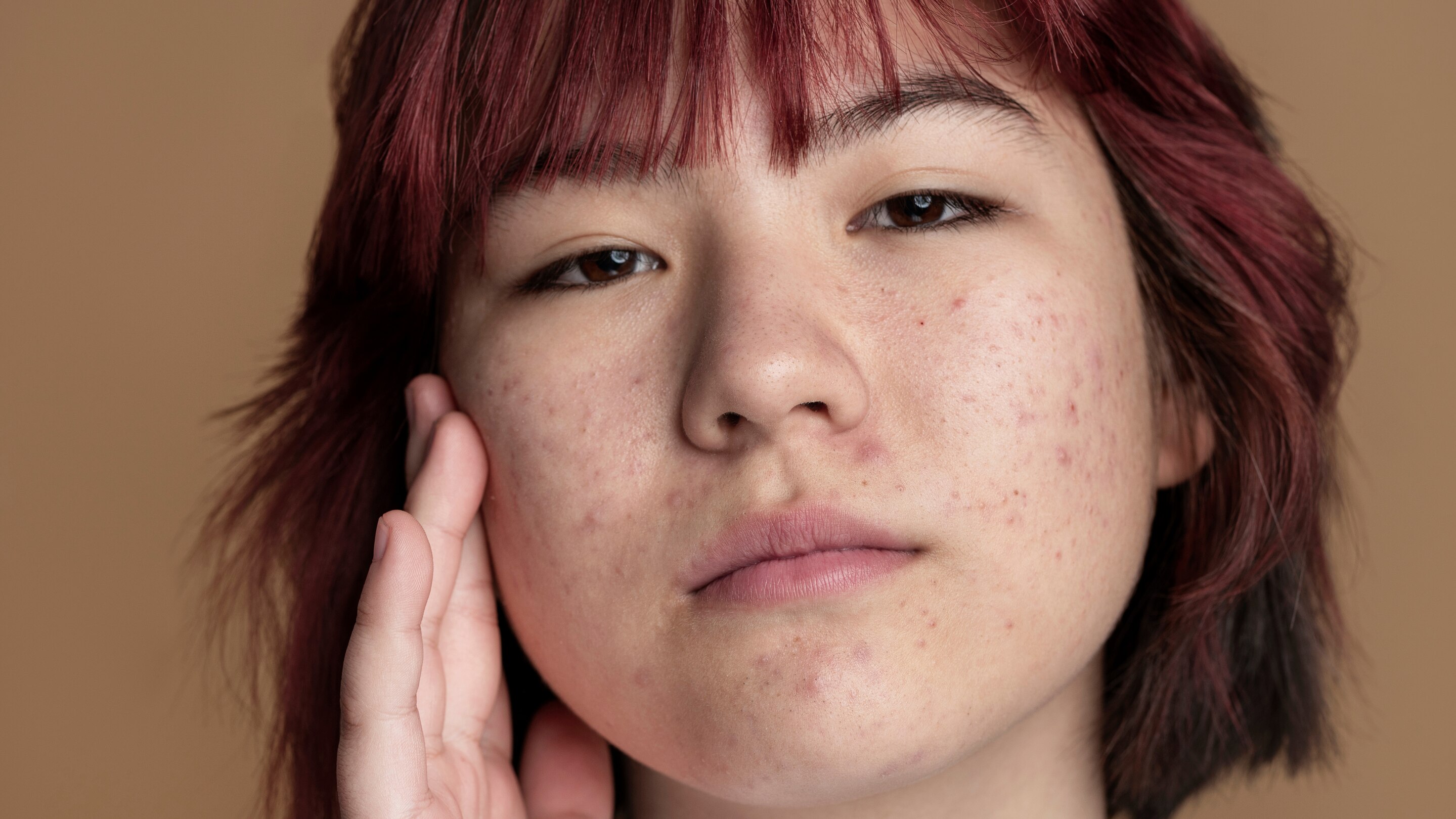 4. Helps Fade Post-Acne Marks