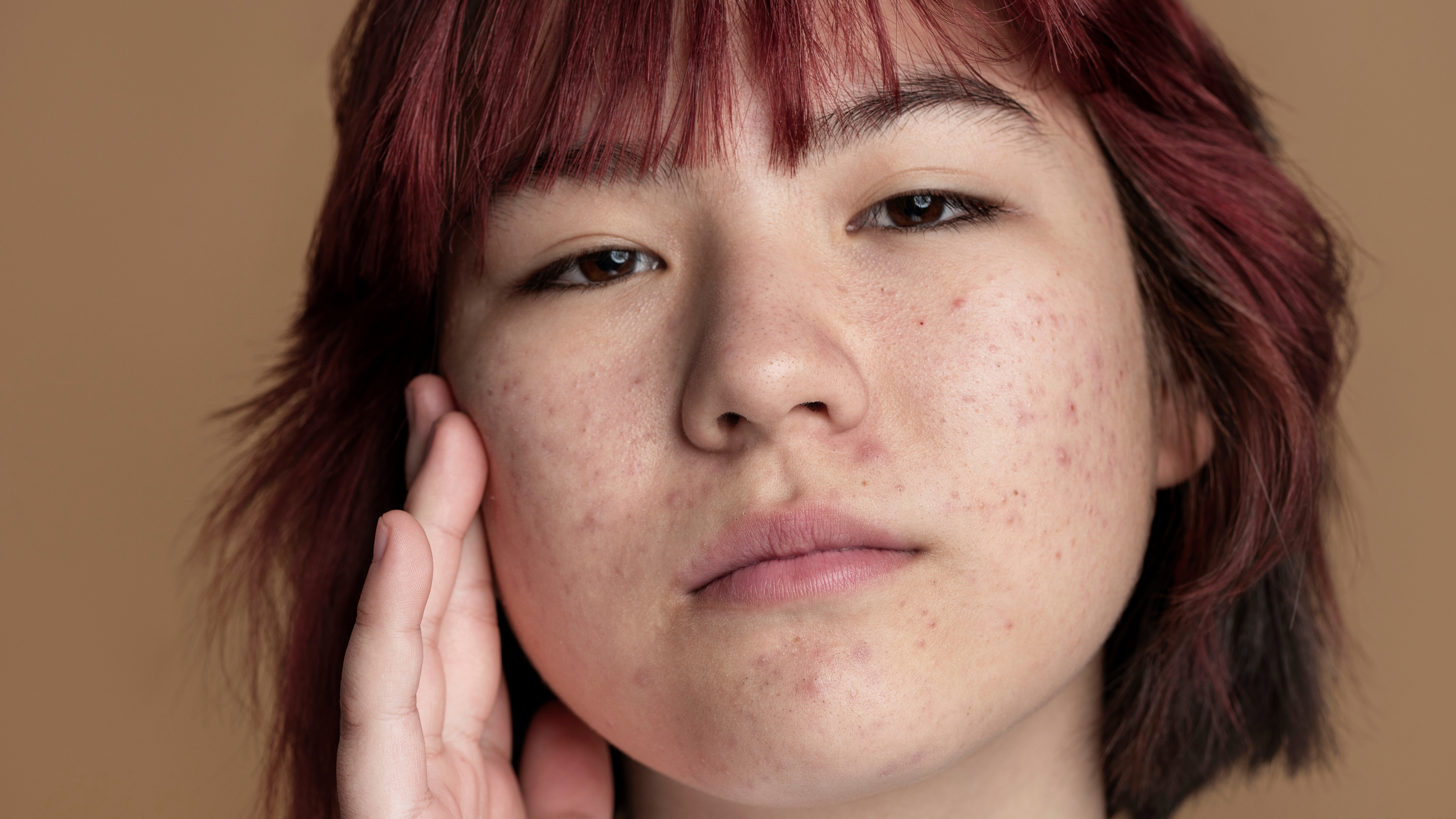 4. Helps Fade Post-Acne Marks