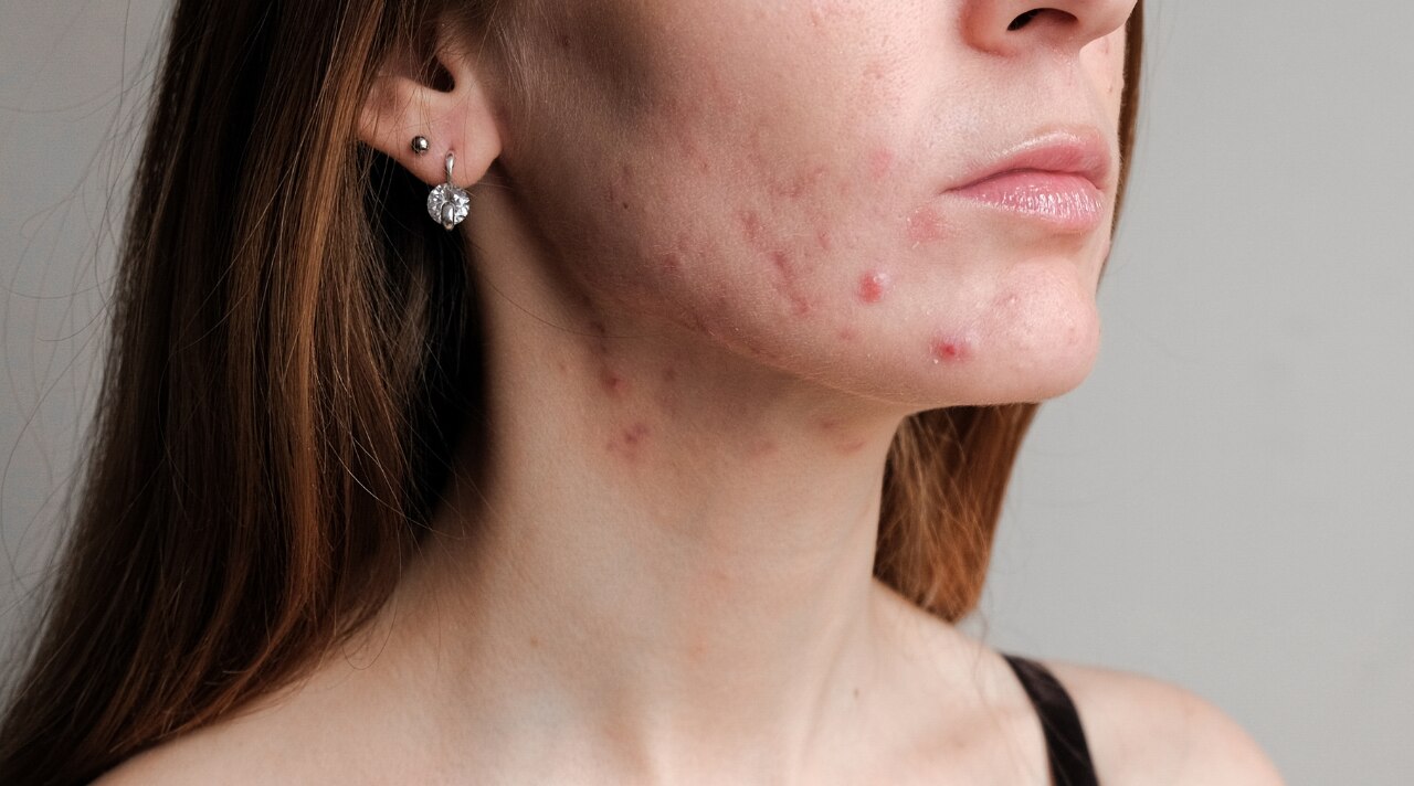 How to Get Rid of Active Acne with Effective Treatments