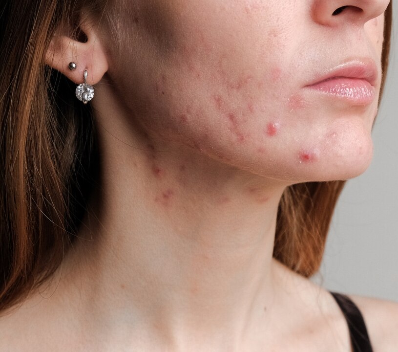 Image of How to Get Rid of Active Acne: What Works and What Doesn't