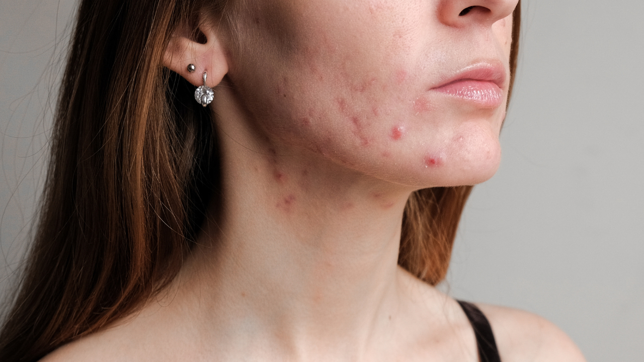 How to Get Rid of Active Acne with Effective Treatments