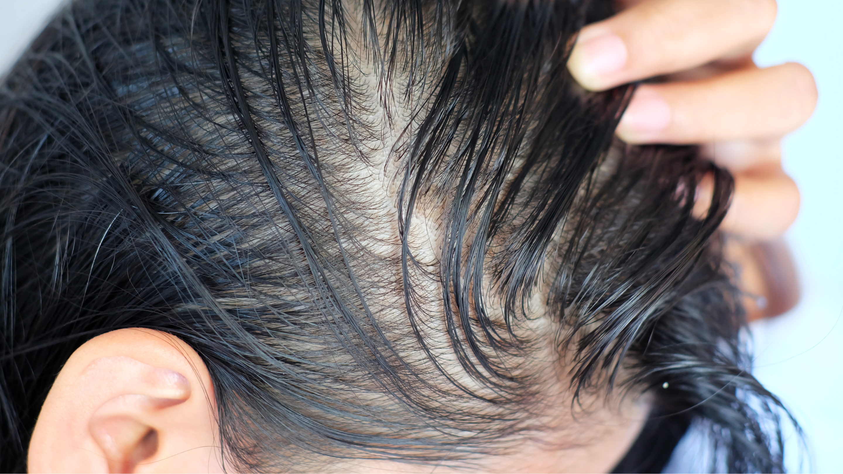 Genetics and DHT sensitivity: