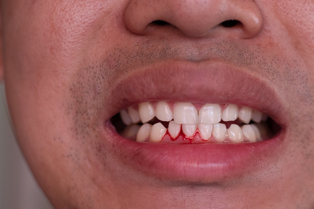 kenapa gusi sering berdarah