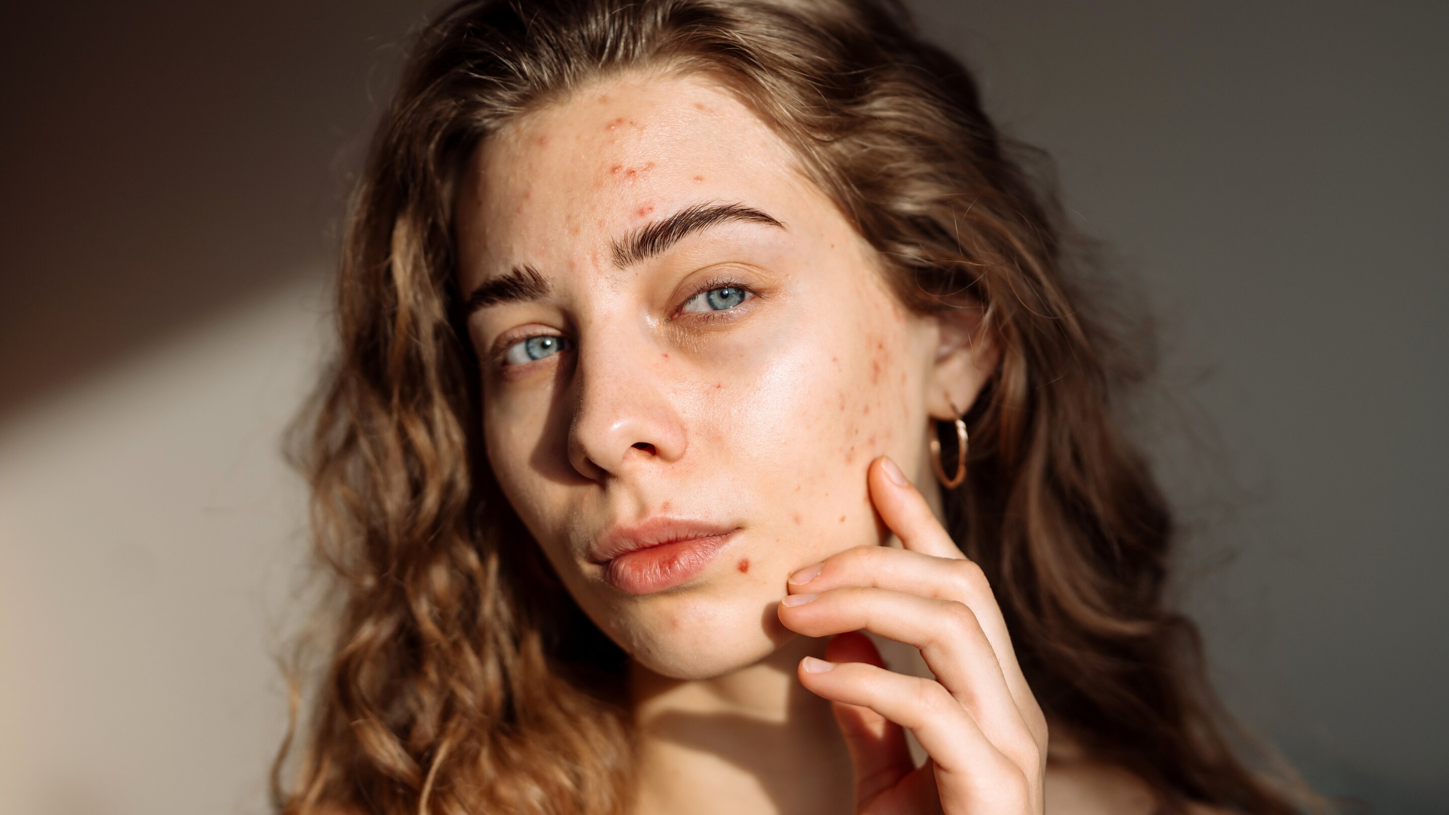 Skincare Routine for Pimples