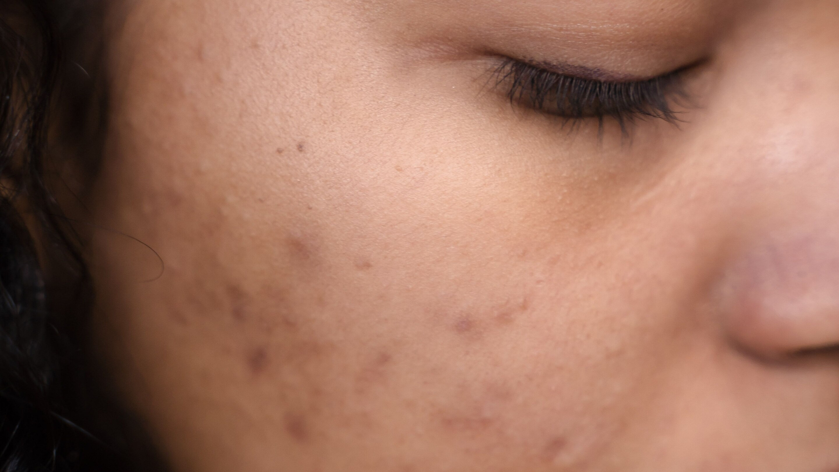 What Causes Pimples?