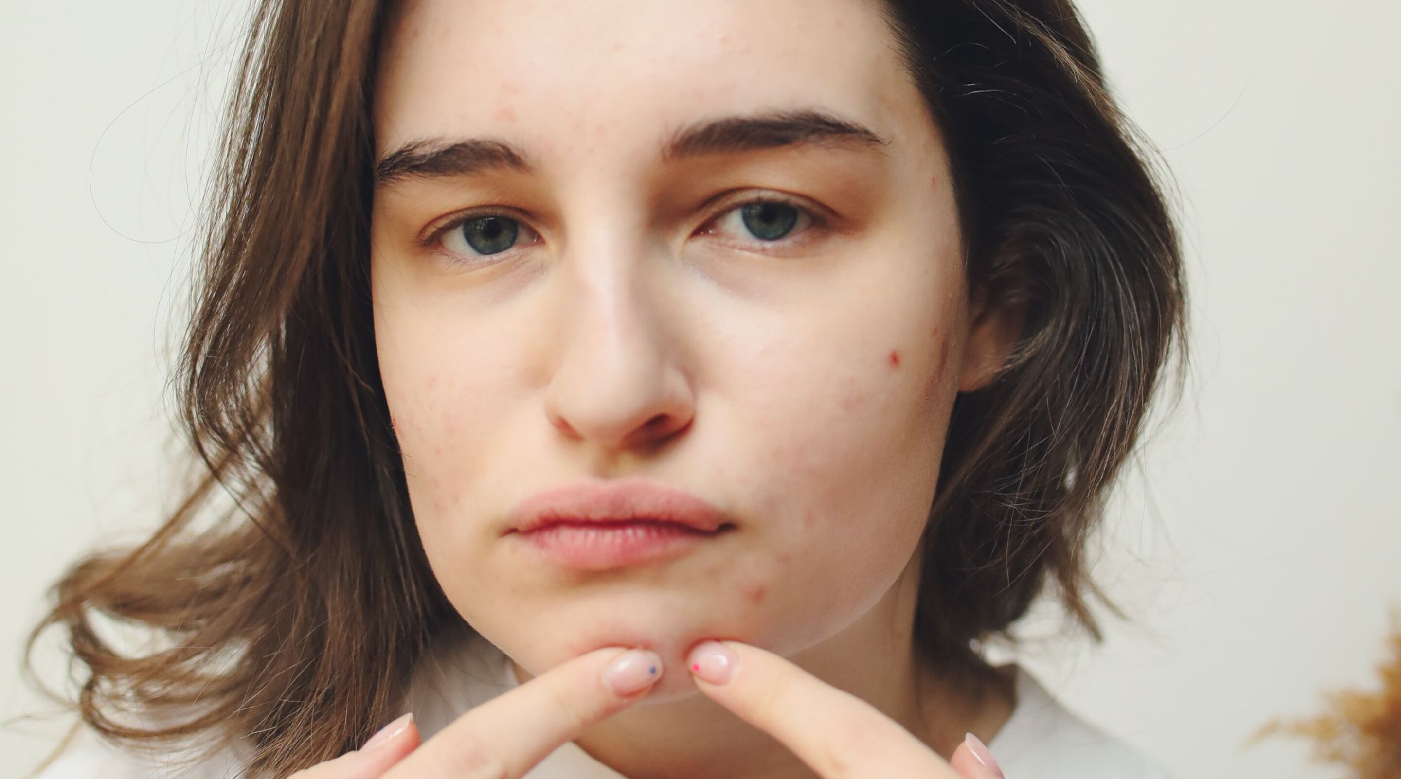 How to Remove Pimples From Face with Effective Treatments