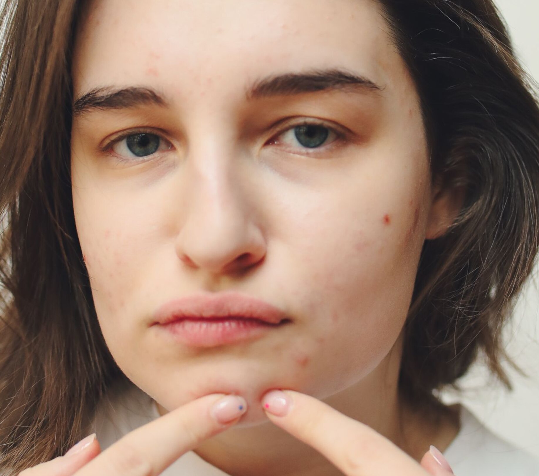 Image of How to Remove Pimples From Face: Causes, Treatments & Top Recommended Products for Pimple